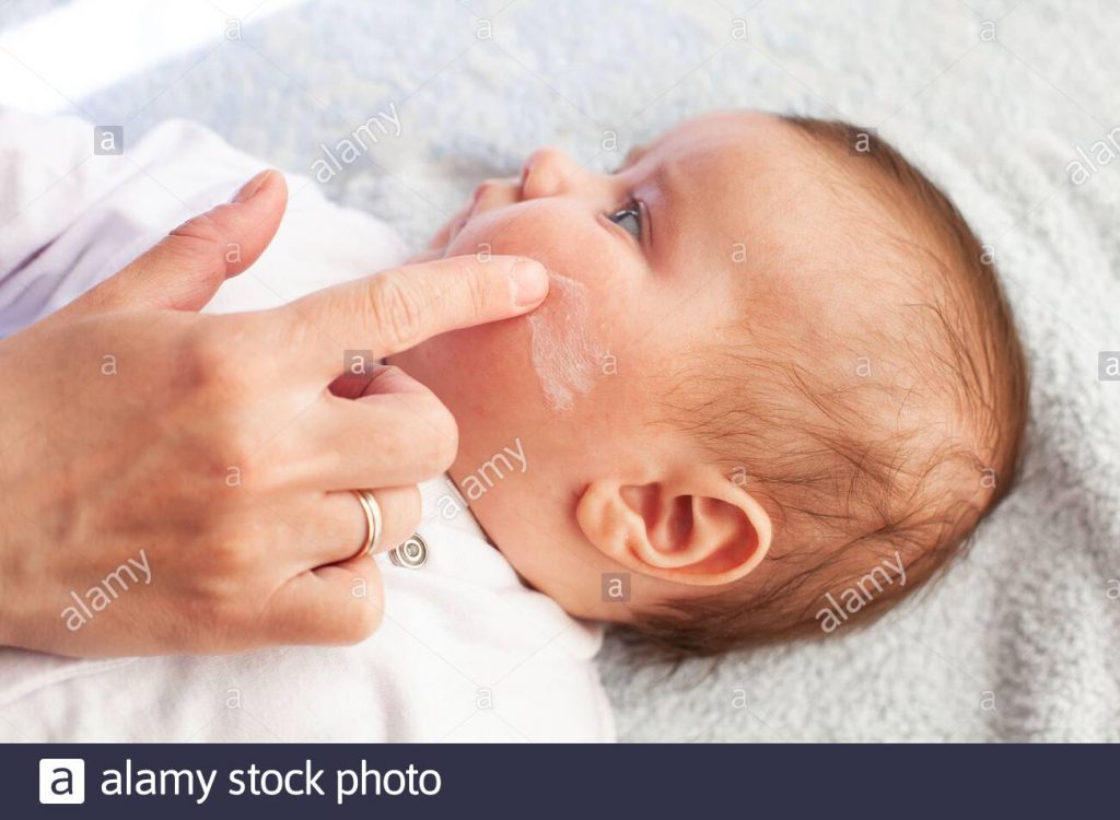 crema dermatitis bebe cara