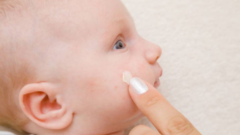 crema para sarpullido cara bebe
